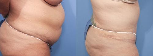Tummy Tuck Before & After Gallery - Patient 58470057 - Image 2