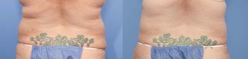 Tummy Tuck Before & After Gallery - Patient 58470057 - Image 3
