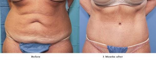 Tummy Tuck Before & After Gallery - Patient 58470058 - Image 1