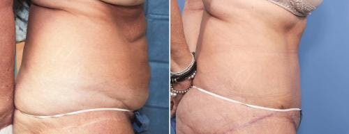 Tummy Tuck Before & After Gallery - Patient 58470058 - Image 2