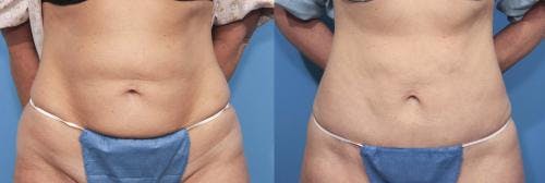 Tummy Tuck Before & After Gallery - Patient 58470059 - Image 1