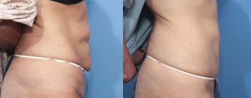 Tummy Tuck Before & After Gallery - Patient 58470059 - Image 2
