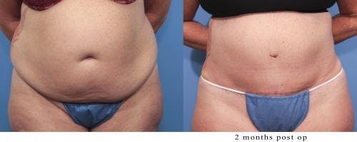 Tummy Tuck Before & After Gallery - Patient 58470061 - Image 1