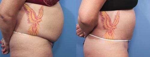 Tummy Tuck Before & After Gallery - Patient 58470061 - Image 2