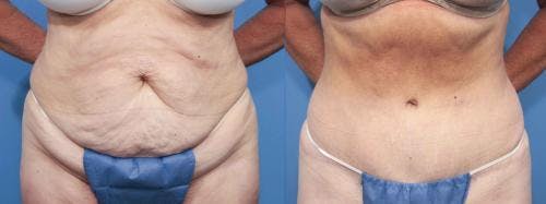 Tummy Tuck Before & After Gallery - Patient 58470062 - Image 1