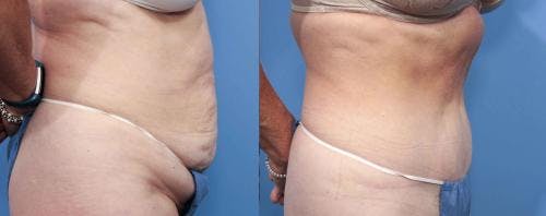 Tummy Tuck Before & After Gallery - Patient 58470062 - Image 2