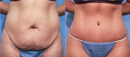 Tummy Tuck Before & After Gallery - Patient 58470063 - Image 1