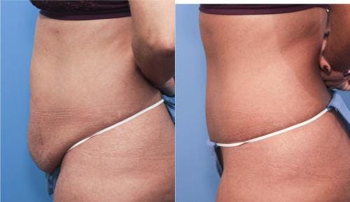 Tummy Tuck Before & After Gallery - Patient 58470063 - Image 2