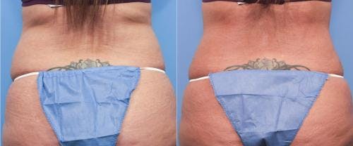 Tummy Tuck Before & After Gallery - Patient 58470063 - Image 3