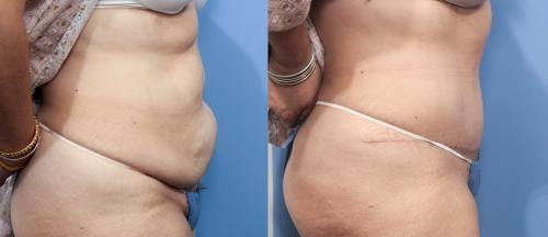 Tummy Tuck Before & After Gallery - Patient 58470064 - Image 2