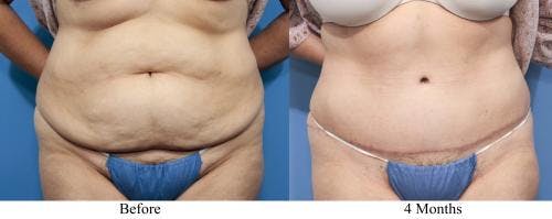 Tummy Tuck Before & After Gallery - Patient 58470064 - Image 1