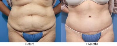 Tummy Tuck Before & After Gallery - Patient 58470064 - Image 1