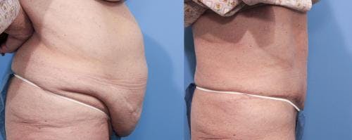 Tummy Tuck Before & After Gallery - Patient 58470096 - Image 2