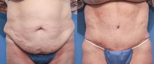 Tummy Tuck Before & After Gallery - Patient 58470096 - Image 1