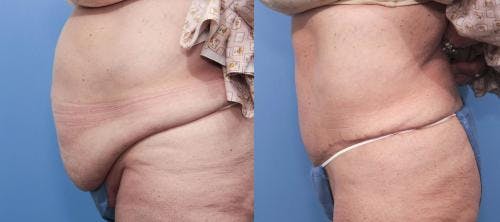 Tummy Tuck Before & After Gallery - Patient 58470096 - Image 3