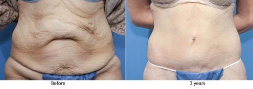 Tummy Tuck Gallery - Patient 58470097 - Image 1