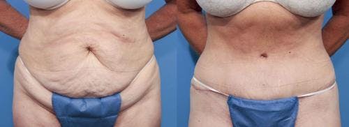 Tummy Tuck Before & After Gallery - Patient 58470098 - Image 1