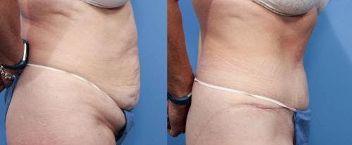 Tummy Tuck Before & After Gallery - Patient 58470098 - Image 2