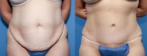 Tummy Tuck Before & After Gallery - Patient 58470104 - Image 1