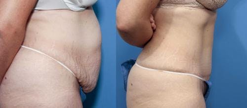 Tummy Tuck Before & After Gallery - Patient 58470104 - Image 2
