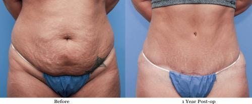 Tummy Tuck Before & After Gallery - Patient 58470105 - Image 1
