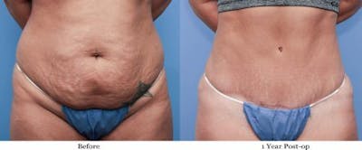 Tummy Tuck Before & After Gallery - Patient 58470105 - Image 1
