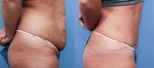 Tummy Tuck Before & After Gallery - Patient 58470105 - Image 2