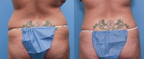 Tummy Tuck Before & After Gallery - Patient 58470105 - Image 3