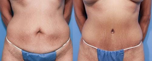 Tummy Tuck Before & After Gallery - Patient 58470106 - Image 1