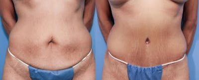 Tummy Tuck Before & After Gallery - Patient 58470106 - Image 1