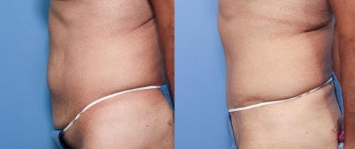 Tummy Tuck Before & After Gallery - Patient 58470106 - Image 2