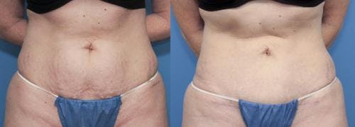 Tummy Tuck Before & After Gallery - Patient 58470108 - Image 1