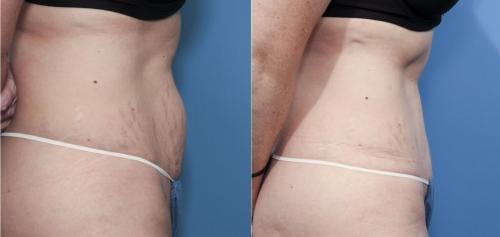Tummy Tuck Before & After Gallery - Patient 58470108 - Image 2