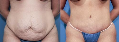 Tummy Tuck Before & After Gallery - Patient 58470109 - Image 1