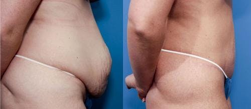 Tummy Tuck Before & After Gallery - Patient 58470109 - Image 2