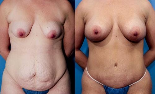 Tummy Tuck Before & After Gallery - Patient 58470109 - Image 3
