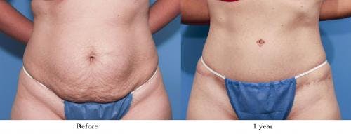 Tummy Tuck Before & After Gallery - Patient 58470110 - Image 1