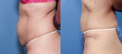 Tummy Tuck Before & After Gallery - Patient 58470110 - Image 2
