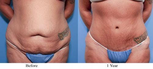 Tummy Tuck Before & After Gallery - Patient 58470111 - Image 1