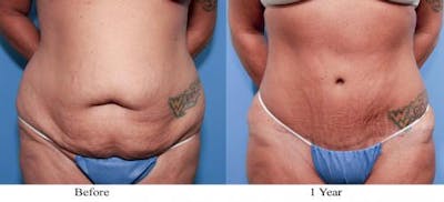 Tummy Tuck Before & After Gallery - Patient 58470111 - Image 1