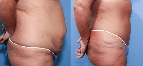 Tummy Tuck Before & After Gallery - Patient 58470111 - Image 2