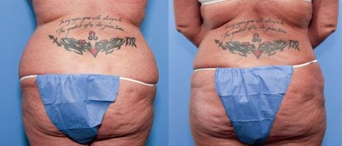 Tummy Tuck Before & After Gallery - Patient 58470111 - Image 3