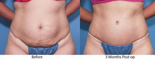 Tummy Tuck Before & After Gallery - Patient 58470113 - Image 1
