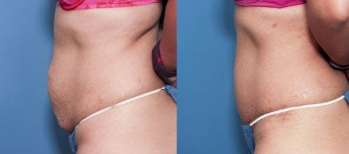 Tummy Tuck Before & After Gallery - Patient 58470113 - Image 2