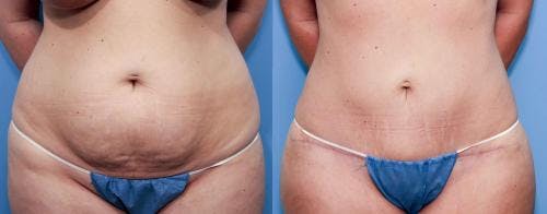 Tummy Tuck Before & After Gallery - Patient 58470114 - Image 1