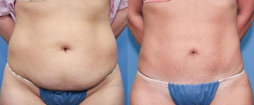 Tummy Tuck Before & After Gallery - Patient 58470115 - Image 1
