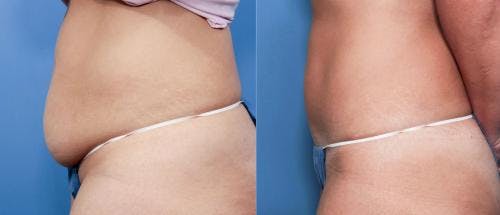 Tummy Tuck Before & After Gallery - Patient 58470115 - Image 2