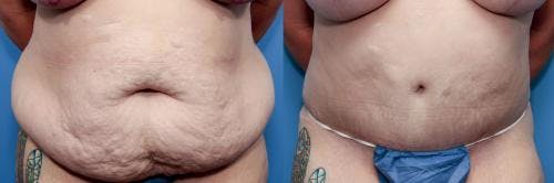 Tummy Tuck Before & After Gallery - Patient 58470122 - Image 1
