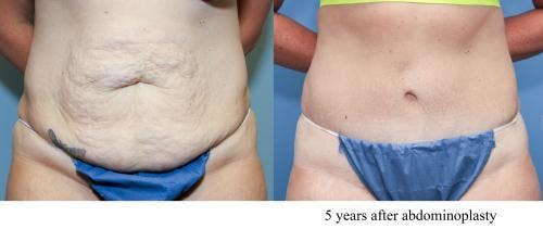 Tummy Tuck Before & After Gallery - Patient 58470124 - Image 1