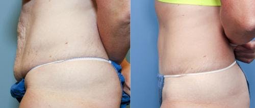 Tummy Tuck Before & After Gallery - Patient 58470124 - Image 2